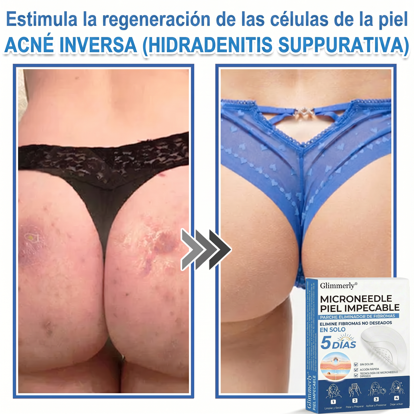 👩‍⚕️ Glimmerly® Parche 2 en 1 de microagujas e hidrocoloide | Eliminador de lunares en relieve, acné, verrugas planas y acrocordones | Mejora arrugas, cicatrices e imperfecciones | Parches invisibles para granos (rostro y cuerpo) | 144 unidades