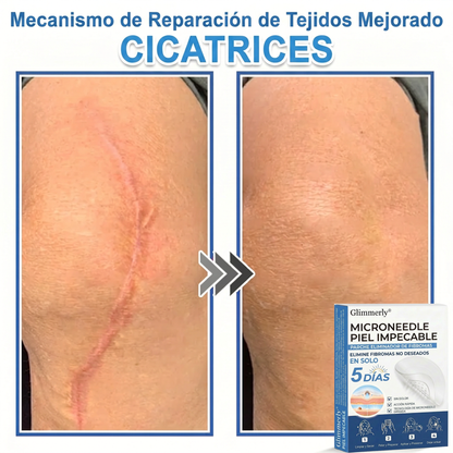 👩‍⚕️ Glimmerly® Parche 2 en 1 de microagujas e hidrocoloide | Eliminador de lunares en relieve, acné, verrugas planas y acrocordones | Mejora arrugas, cicatrices e imperfecciones | Parches invisibles para granos (rostro y cuerpo) | 144 unidades