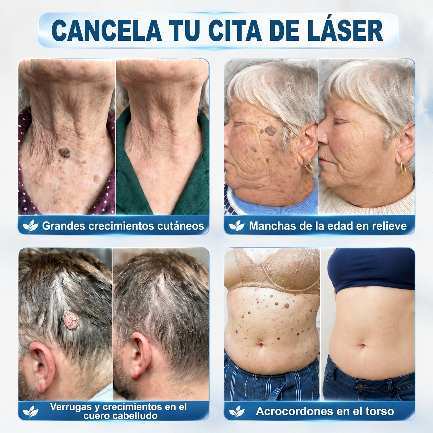 🎋🎋𝐏𝐢𝐜𝐝𝐨® 𝐁𝐨𝐫𝐫𝐚𝐝𝐨𝐫 𝐝𝐞 𝐕𝐞𝐫𝐫𝐮𝐠𝐚𝐬 𝐲 𝐌𝐚𝐧𝐜𝐡𝐚𝐬 𝐝𝐞 𝟕 𝐃í𝐚𝐬 (Aplicador roll-on: sin dolor ni cicatrices)