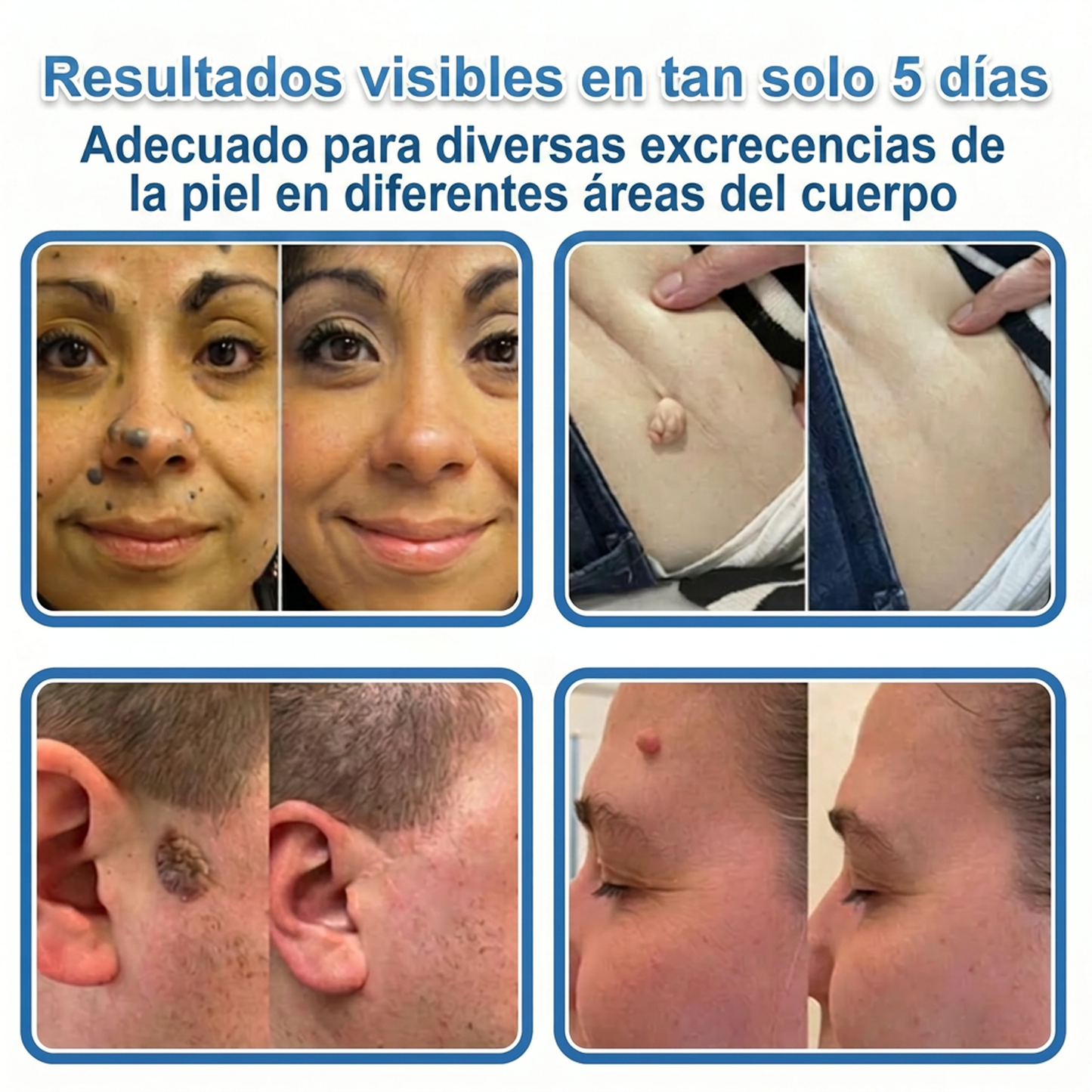 👩‍⚕️ Glimmerly® Parche 2 en 1 de microagujas e hidrocoloide | Eliminador de lunares en relieve, acné, verrugas planas y acrocordones | Mejora arrugas, cicatrices e imperfecciones | Parches invisibles para granos (rostro y cuerpo) | 144 unidades