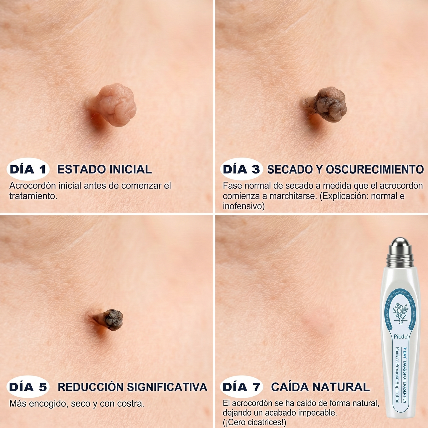 🎋🎋𝐏𝐢𝐜𝐝𝐨® 𝐁𝐨𝐫𝐫𝐚𝐝𝐨𝐫 𝐝𝐞 𝐕𝐞𝐫𝐫𝐮𝐠𝐚𝐬 𝐲 𝐌𝐚𝐧𝐜𝐡𝐚𝐬 𝐝𝐞 𝟕 𝐃í𝐚𝐬 (Aplicador roll-on: sin dolor ni cicatrices)
