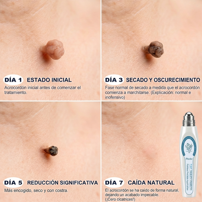 🎋🎋𝐏𝐢𝐜𝐝𝐨® 𝐁𝐨𝐫𝐫𝐚𝐝𝐨𝐫 𝐝𝐞 𝐕𝐞𝐫𝐫𝐮𝐠𝐚𝐬 𝐲 𝐌𝐚𝐧𝐜𝐡𝐚𝐬 𝐝𝐞 𝟕 𝐃í𝐚𝐬 (Aplicador roll-on: sin dolor ni cicatrices)