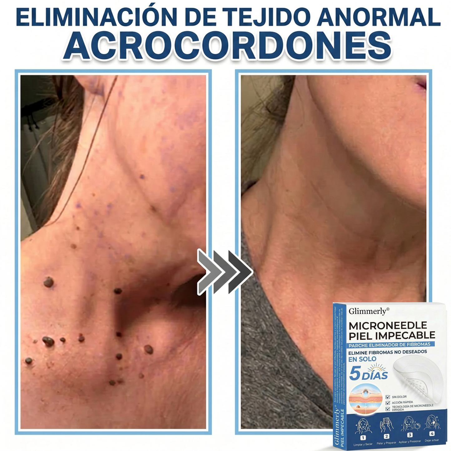 👩‍⚕️ Glimmerly® Parche 2 en 1 de microagujas e hidrocoloide | Eliminador de lunares en relieve, acné, verrugas planas y acrocordones | Mejora arrugas, cicatrices e imperfecciones | Parches invisibles para granos (rostro y cuerpo) | 144 unidades