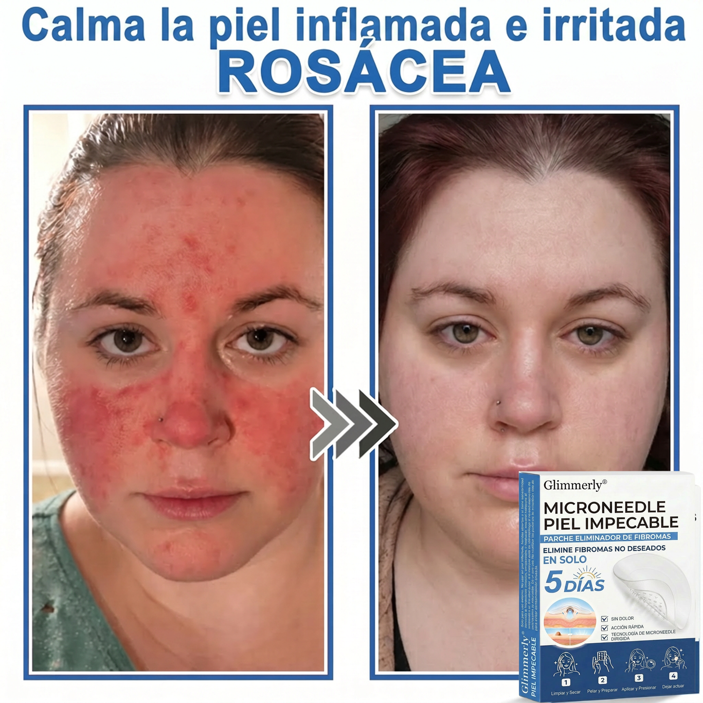 👩‍⚕️ Glimmerly® Parche 2 en 1 de microagujas e hidrocoloide | Eliminador de lunares en relieve, acné, verrugas planas y acrocordones | Mejora arrugas, cicatrices e imperfecciones | Parches invisibles para granos (rostro y cuerpo) | 144 unidades