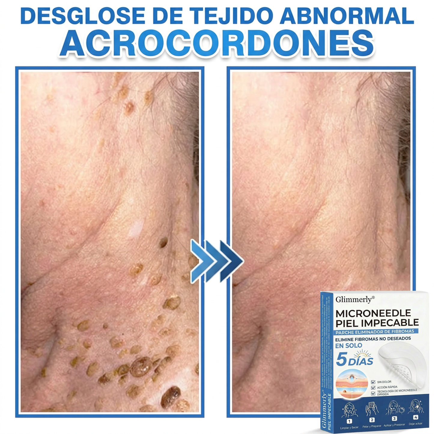 👩‍⚕️ Glimmerly® Parche 2 en 1 de microagujas e hidrocoloide | Eliminador de lunares en relieve, acné, verrugas planas y acrocordones | Mejora arrugas, cicatrices e imperfecciones | Parches invisibles para granos (rostro y cuerpo) | 144 unidades