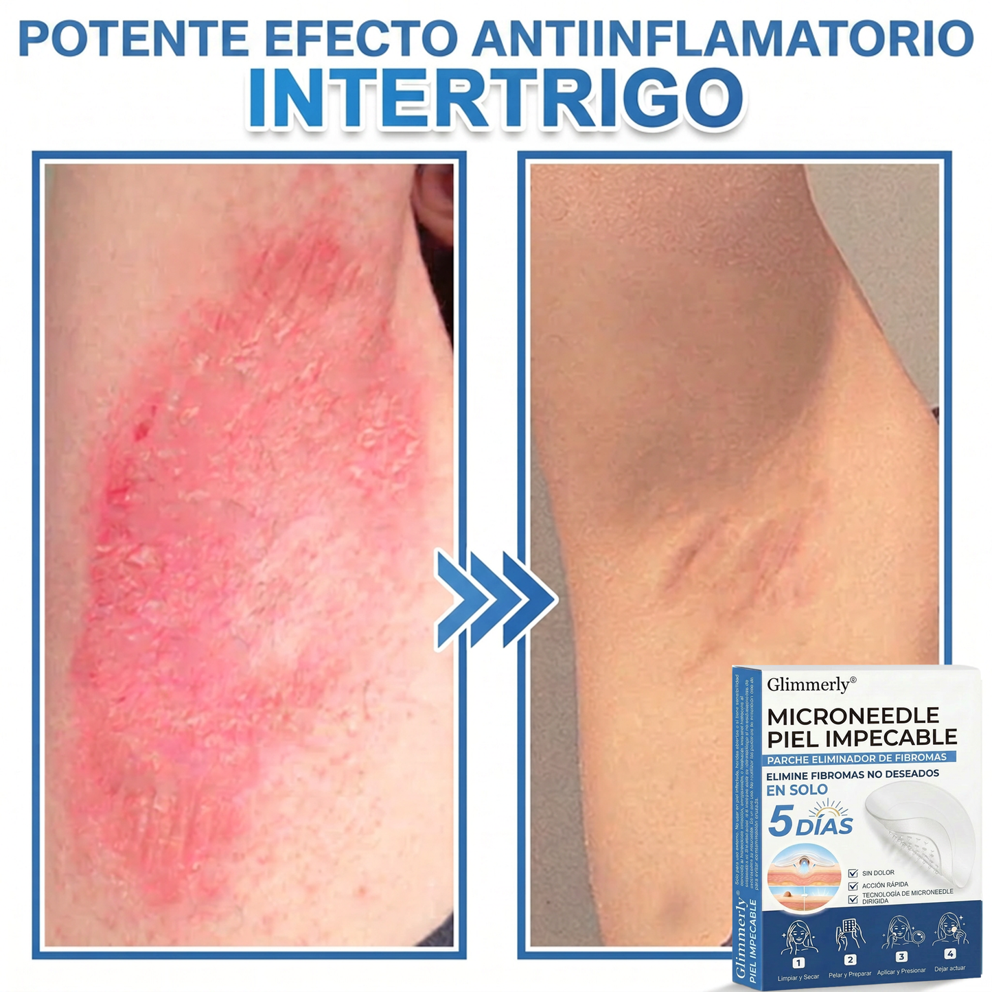 👩‍⚕️ Glimmerly® Parche 2 en 1 de microagujas e hidrocoloide | Eliminador de lunares en relieve, acné, verrugas planas y acrocordones | Mejora arrugas, cicatrices e imperfecciones | Parches invisibles para granos (rostro y cuerpo) | 144 unidades